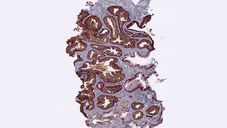 Cancer Diagnosis